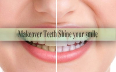 Makeover Teeth: Shine your smile